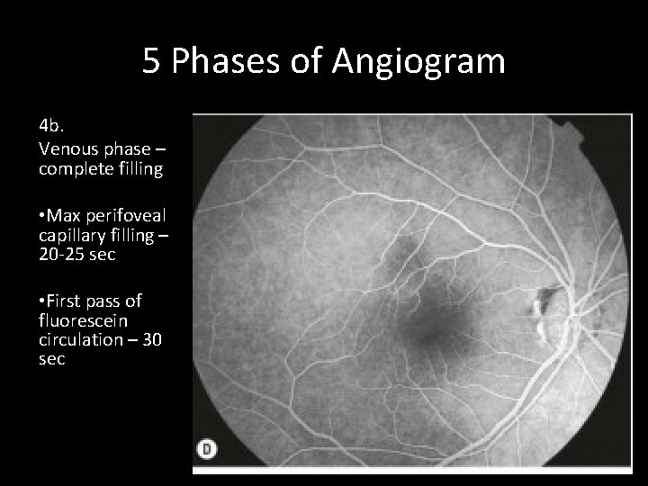 5 Phases of Angiogram 4 b. Venous phase – complete filling • Max perifoveal