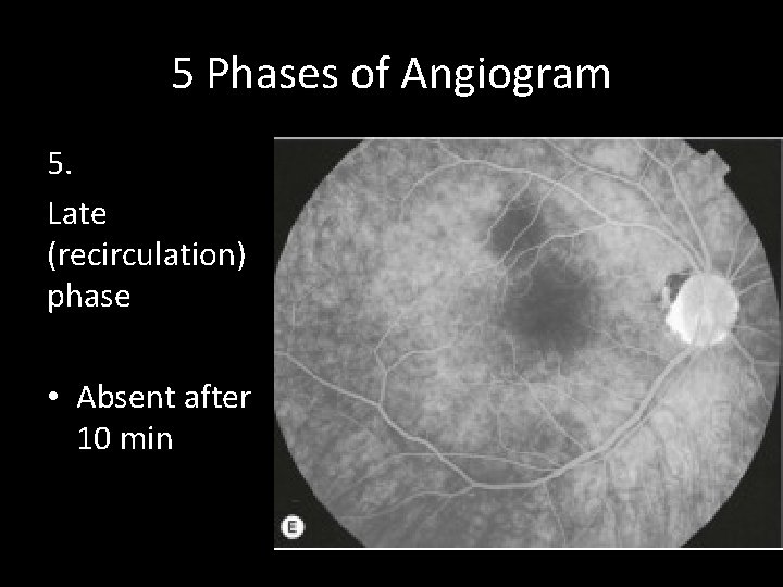 5 Phases of Angiogram 5. Late (recirculation) phase • Absent after 10 min 