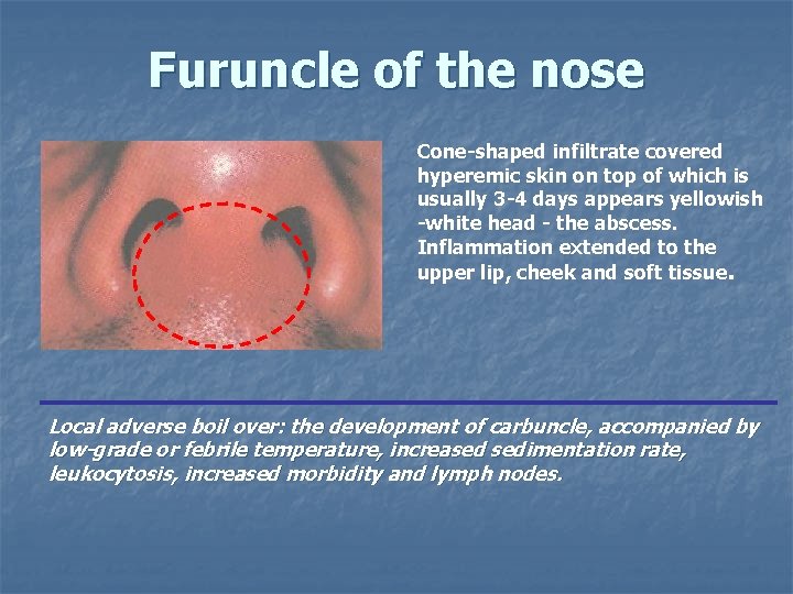 Furuncle of the nose Cone-shaped infiltrate covered hyperemic skin on top of which is