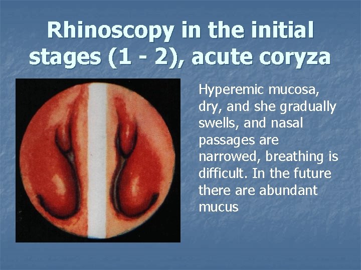Rhinoscopy in the initial stages (1 - 2), acute coryza Hyperemic mucosa, dry, and