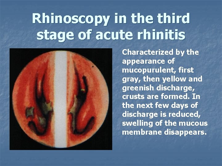 Rhinoscopy in the third stage of acute rhinitis Characterized by the appearance of mucopurulent,
