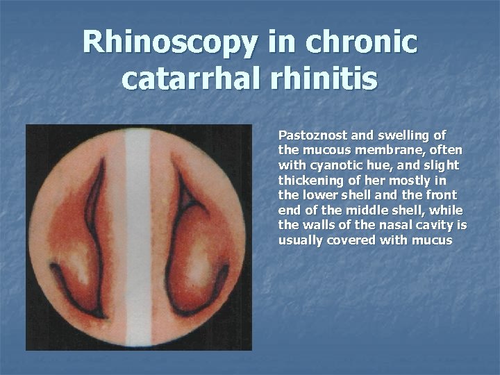 Rhinoscopy in chronic catarrhal rhinitis Pastoznost and swelling of the mucous membrane, often with