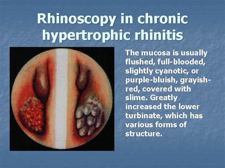 Rhinoscopy in chronic hypertrophic rhinitis The mucosa is usually flushed, full-blooded, slightly cyanotic, or