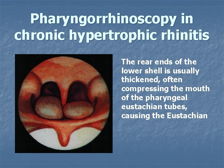 Pharyngorrhinoscopy in chronic hypertrophic rhinitis The rear ends of the lower shell is usually