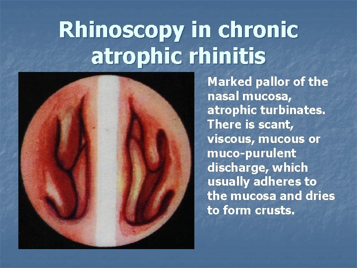 Rhinoscopy in chronic atrophic rhinitis Marked pallor of the nasal mucosa, atrophic turbinates. There