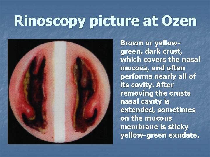 Rinoscopy picture at Ozen Brown or yellowgreen, dark crust, which covers the nasal mucosa,
