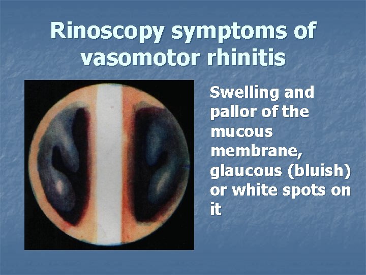 Rinoscopy symptoms of vasomotor rhinitis Swelling and pallor of the mucous membrane, glaucous (bluish)