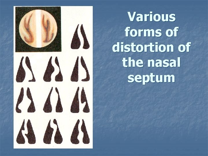 Various forms of distortion of the nasal septum 