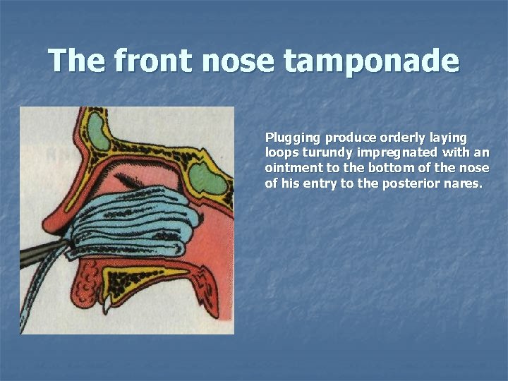 The front nose tamponade Plugging produce orderly laying loops turundy impregnated with an ointment
