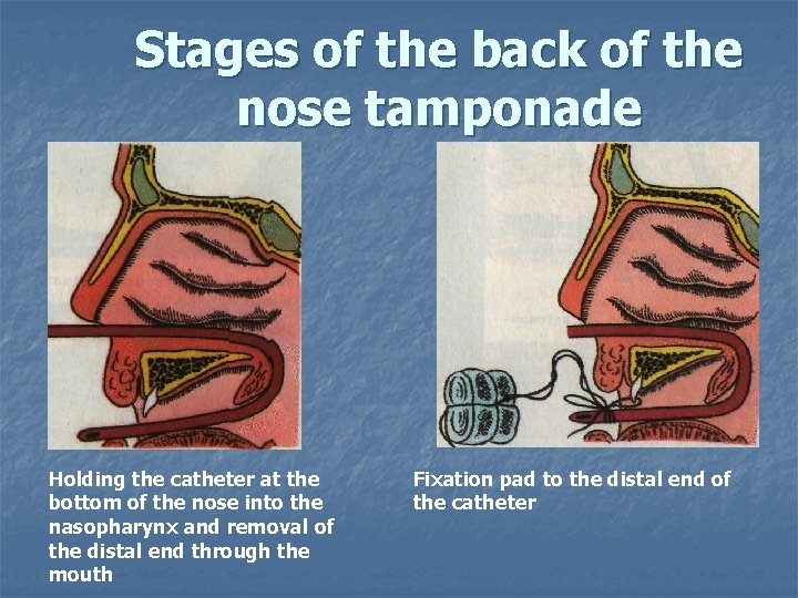 Stages of the back of the nose tamponade Holding the catheter at the bottom