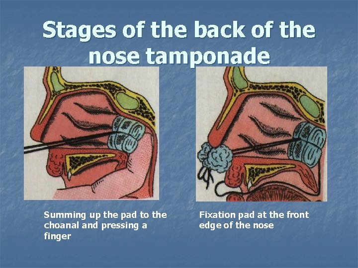 Stages of the back of the nose tamponade Summing up the pad to the