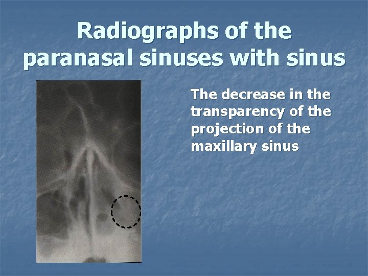 Radiographs of the paranasal sinuses with sinus The decrease in the transparency of the