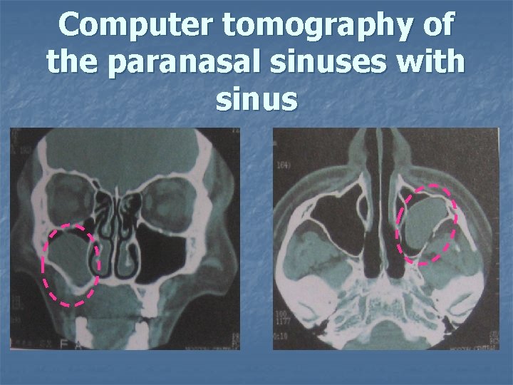 Computer tomography of the paranasal sinuses with sinus 