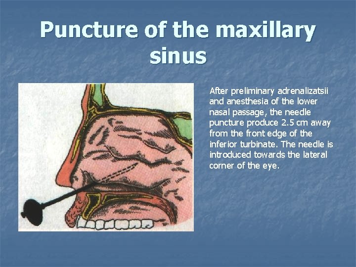 Puncture of the maxillary sinus After preliminary adrenalizatsii and anesthesia of the lower nasal
