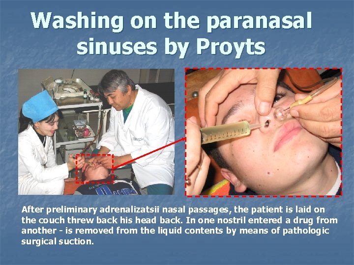 Washing on the paranasal sinuses by Proyts After preliminary adrenalizatsii nasal passages, the patient