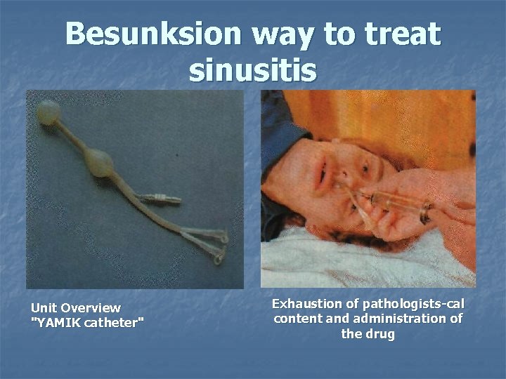 Besunksion way to treat sinusitis Unit Overview "YAMIK catheter" Exhaustion of pathologists-cal content and