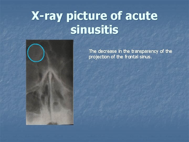 X-ray picture of acute sinusitis The decrease in the transparency of the projection of