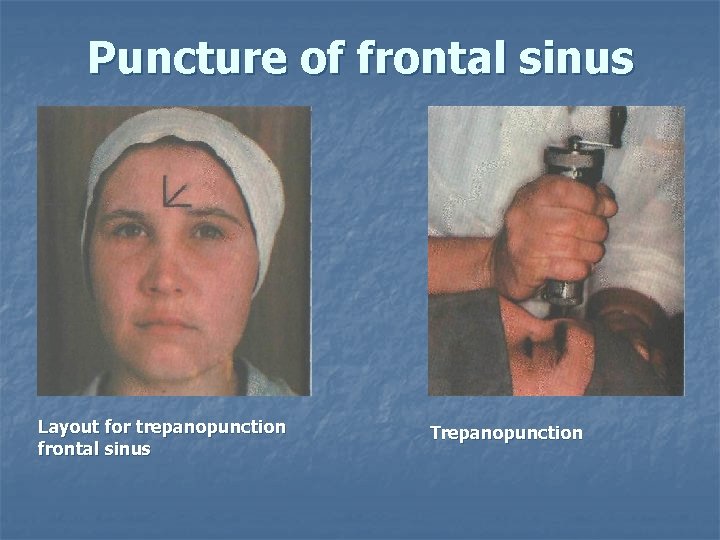 Puncture of frontal sinus Layout for trepanopunction frontal sinus Trepanopunction 