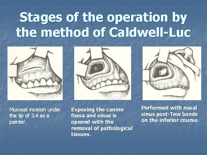 Stages of the operation by the method of Caldwell-Luc Mucosal incision under the lip