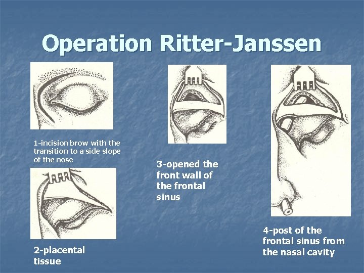Operation Ritter-Janssen 1 -incision brow with the transition to a side slope of the