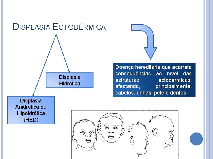 DISPLASIA ECTODÉRMICA Displasia Hidrótica Displasia Anidrótica ou Hipoidrótica (HED) Doença hereditária que acarreta consequências