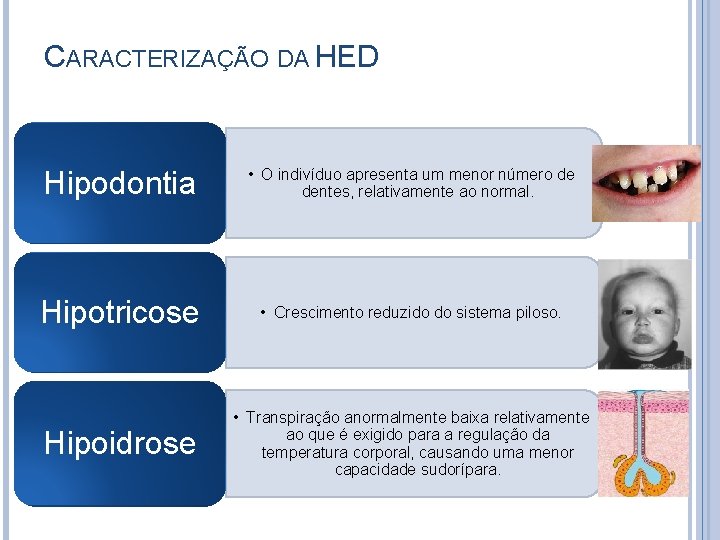 CARACTERIZAÇÃO DA HED Hipodontia • O indivíduo apresenta um menor número de dentes, relativamente