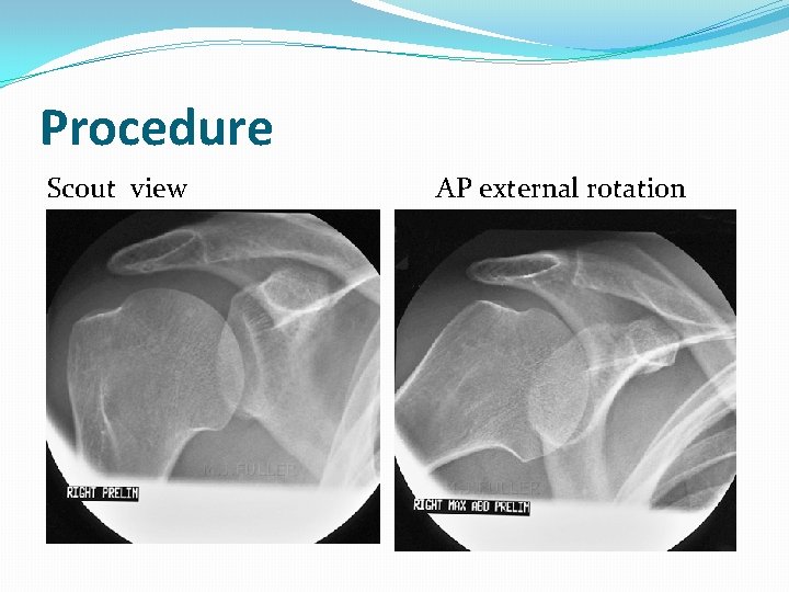 Procedure Scout view AP external rotation 