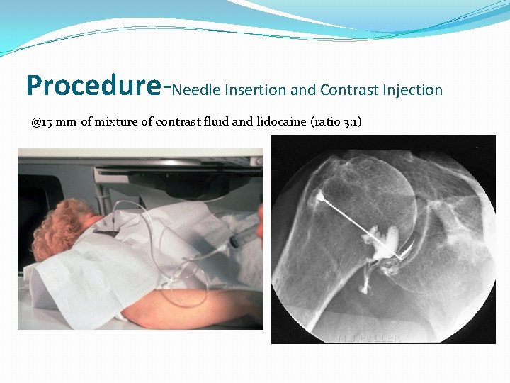 Procedure-Needle Insertion and Contrast Injection @15 mm of mixture of contrast fluid and lidocaine