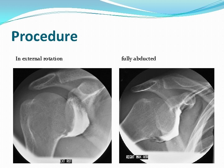 Procedure In external rotation fully abducted 