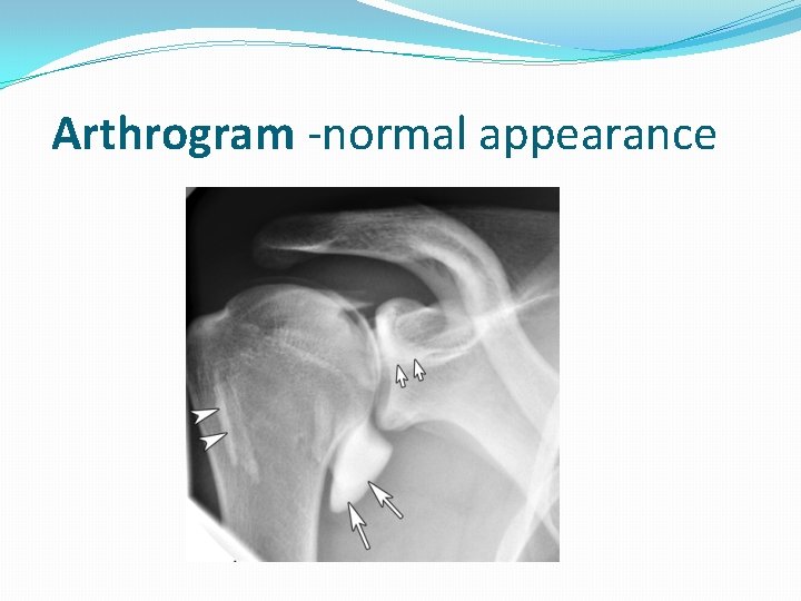  Arthrogram -normal appearance 