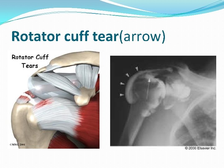 Rotator cuff tear(arrow) 