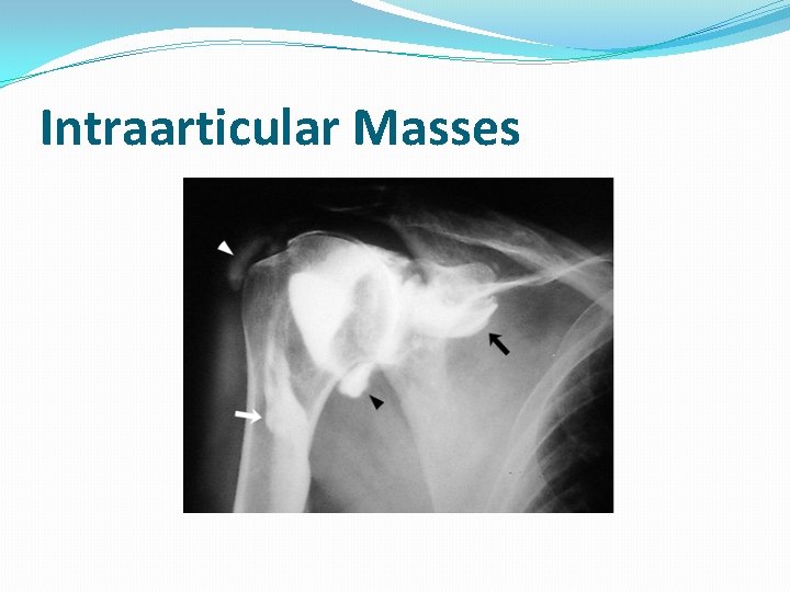 Intraarticular Masses 