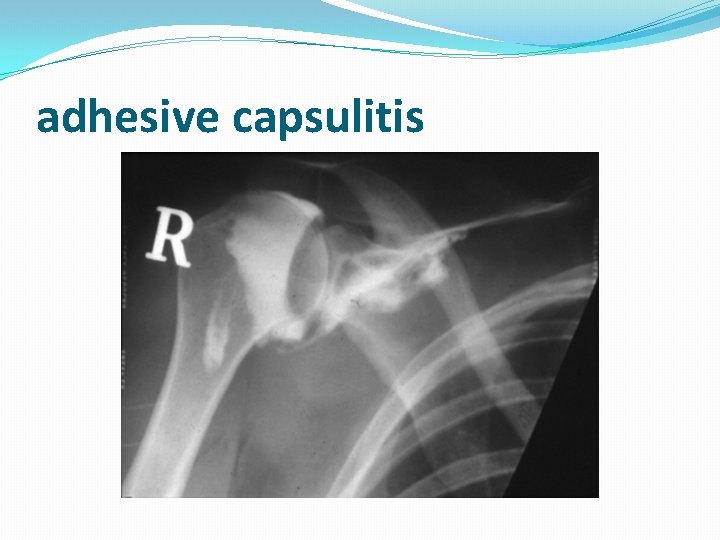 adhesive capsulitis 