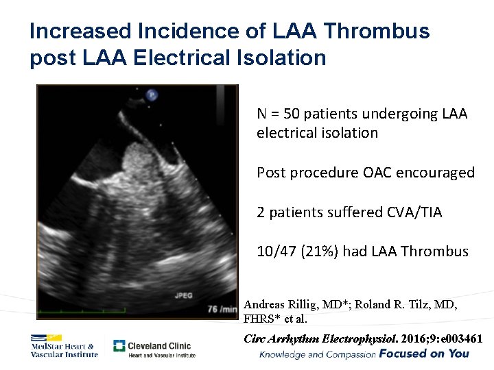 Increased Incidence of LAA Thrombus post LAA Electrical Isolation N = 50 patients undergoing
