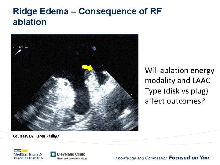 Ridge Edema – Consequence of RF ablation Will ablation energy modality and LAAC Type