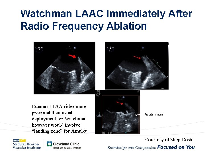 Watchman LAAC Immediately After Radio Frequency Ablation edema Edema at LAA ridge more proximal