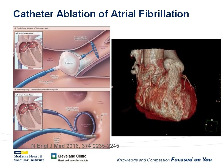 Catheter Ablation of Atrial Fibrillation N Engl J Med 2016; 374: 2235 -2245 