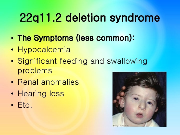 22 q 11. 2 deletion syndrome • The Symptoms (less common): • Hypocalcemia • 22 q 11. 2 deletion syndrome • The Symptoms (less common): • Hypocalcemia •