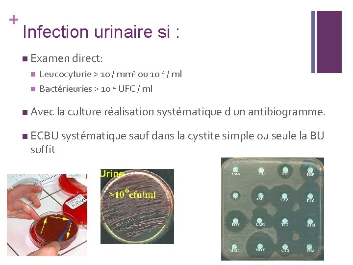 + Infection urinaire si : n Examen direct: n n Leucocyturie > 10 /