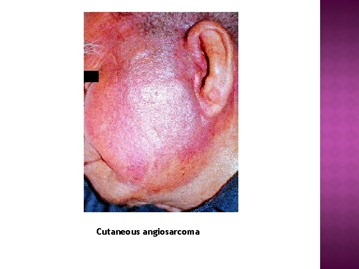 Cutaneous angiosarcoma 