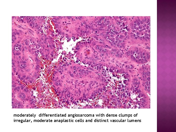 moderately differentiated angiosarcoma with dense clumps of irregular, moderate anaplastic cells and distinct vascular