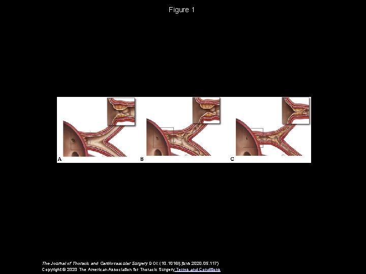 Figure 1 The Journal of Thoracic and Cardiovascular Surgery DOI: (10. 1016/j. jtcvs. 2020.