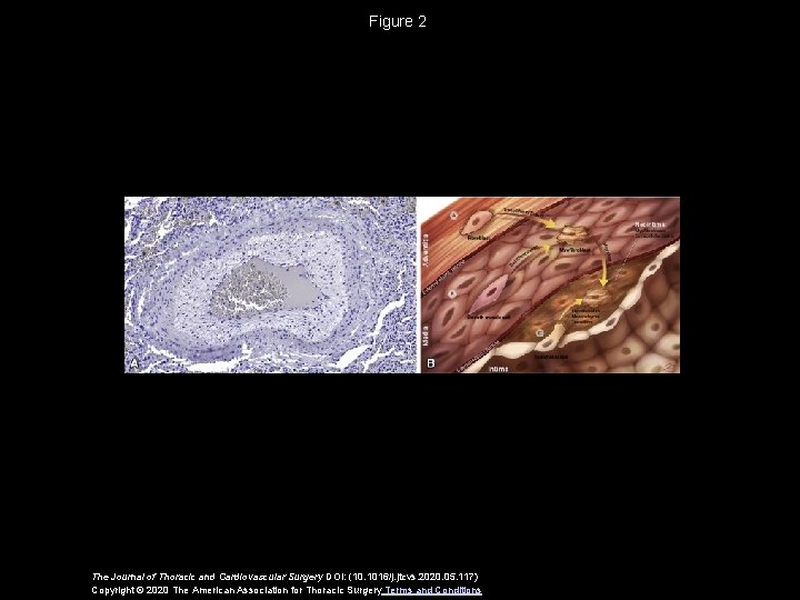 Figure 2 The Journal of Thoracic and Cardiovascular Surgery DOI: (10. 1016/j. jtcvs. 2020.