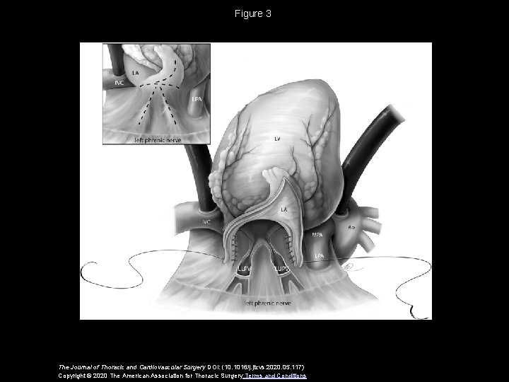 Figure 3 The Journal of Thoracic and Cardiovascular Surgery DOI: (10. 1016/j. jtcvs. 2020.