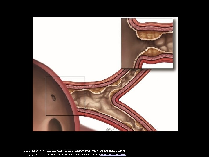 The Journal of Thoracic and Cardiovascular Surgery DOI: (10. 1016/j. jtcvs. 2020. 05. 117)