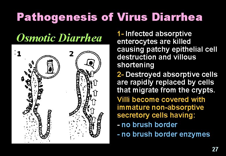 Pathogenesis of Virus Diarrhea Osmotic Diarrhea 1 - Infected absorptive enterocytes are killed causing