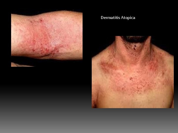 Dermatitis Atopica 