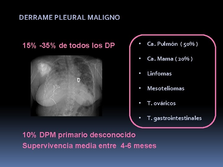 DERRAME PLEURAL MALIGNO 15% -35% de todos los DP • Ca. Pulmón ( 50%