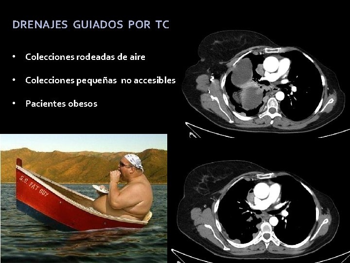 DRENAJES GUIADOS POR TC • Colecciones rodeadas de aire • Colecciones pequeñas no accesibles