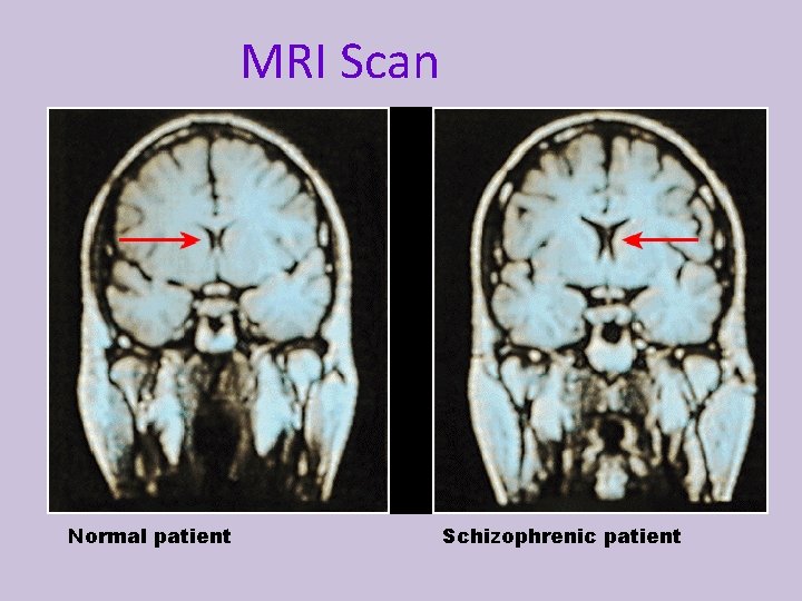 MRI Scan Normal patient Schizophrenic patient 